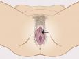 Órgãos sexuais visíveis da mulher com indicação do meato urinário