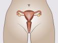 DIU (dispositif intra-utérin) placé dans l’utérus