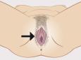 Visión en conjunto de la vulva