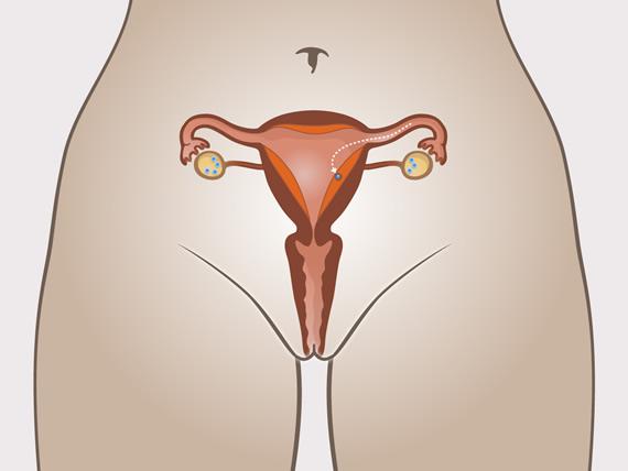 implantarea penisului pastile pentru erecție