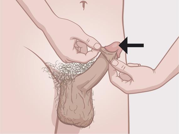penisul unui bărbat prin aspectul său de ce nu există ungere în timpul erecției