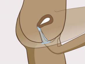 Insira um dedo por dentro do preservativo e empurre o anel o mais profundamente possível na vagina.