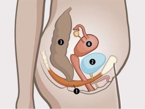 Detaliu al pelvisului feminin: 1. mușchii pelvieni care susțin 2. vezica urinară, 3. intestinele și 4. uterul. 