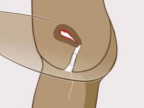 Tampon în interiorul vaginului