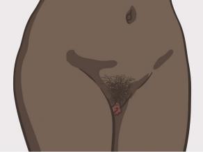Verschillende vulva's: voorbeeld 2
