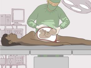 Chirurgische Entbindung: Ein Arzt, der einen Kaiserschnitt durchführt
