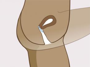 L’anneau est inséré correctement dans le vagin.