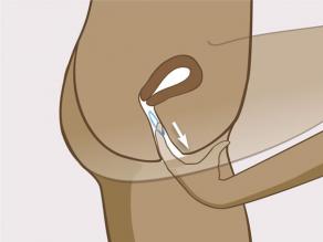 Para retirar o anel, insira o seu dedo na vagina e enganche o anel. Puxe cuidadosamente o anel para fora.