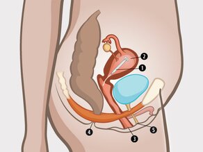 Detail van het bekken van de vrouw: 1. hormonaal spiraal, 2. baarmoeder, 3. vagina, 4. anus en 5. plasgaatje.