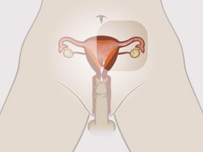 Мъж еякулира във влагалището на жената. Сперматозоидът започва да плува към яйцеклетката.