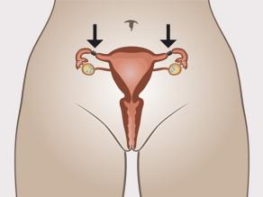 Стерилизация женщин: происходит блокирование фаллопиевых труб.
