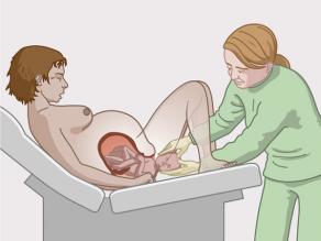 Natuurlijke bevalling: vrouw bevalt van haar baby.