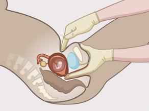Detail van een vaginaal onderzoek: de dokter brengt enkele vingers in de vagina in om te voelen of de baarmoederhals al opening heeft. Hij/zij controleert langs de buitenkant ook de ligging van de baarmoeder.