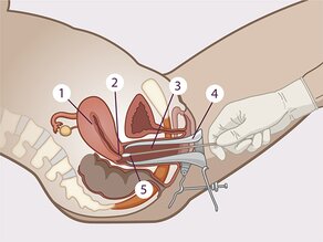 Utérus (1), col de l’utérus (2) et vagin (3) avec le spéculum (4) en détail. Le frottis est effectué avec un écouvillon de prélèvement (5). 