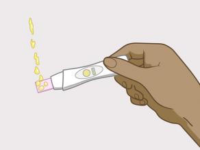 You can urinate directly on the tip of the pregnancy test.
