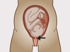 Le col de l’utérus, c.-à-d. l’entrée de l’utérus, s’ouvre pendant les contractions.