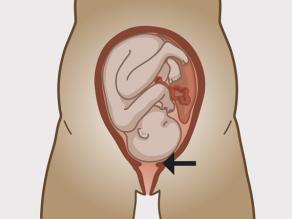 Colul uterin se dilată.