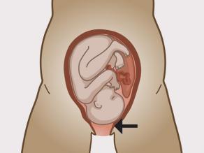 When the cervix is open wide enough, the baby can be born.