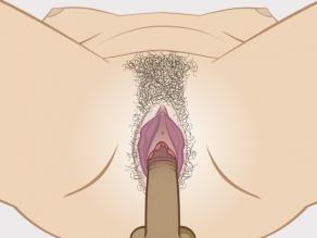 Detail of a wider hymen that does not tear during sexual intercourse. This is what happens in most cases.