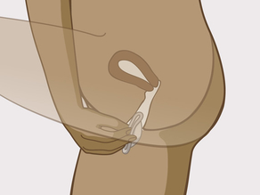 Houd de holle kant van het pessarium naar de baarmoeder gedraaid. 