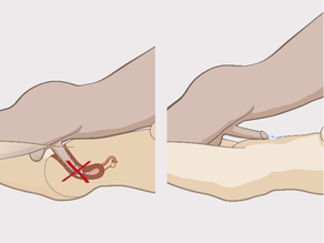 Withdrawal method: the man removes his penis from the vagina before he ejaculates.