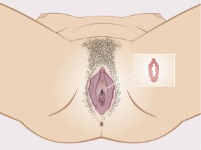 Detalhe do hímen dentro da vagina: uma borda de tecido flexível. O hímen não é uma membrana que feche a vagina.